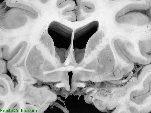 Anterior Commissure Coronal